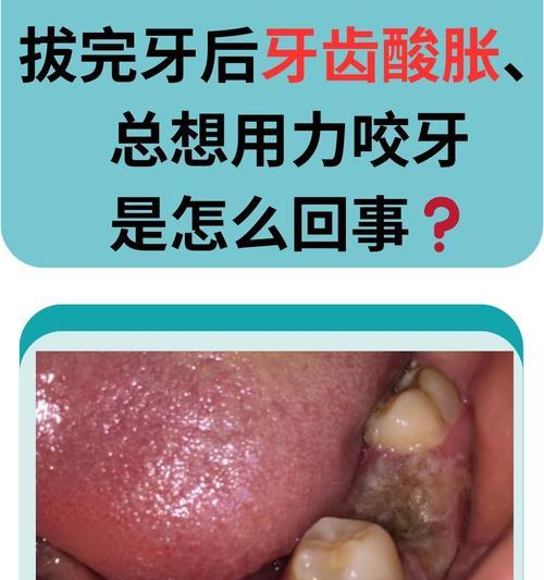 智齿难拔的原因及应对方法（了解智齿难拔的关键原因，采取正确方法解决问题）